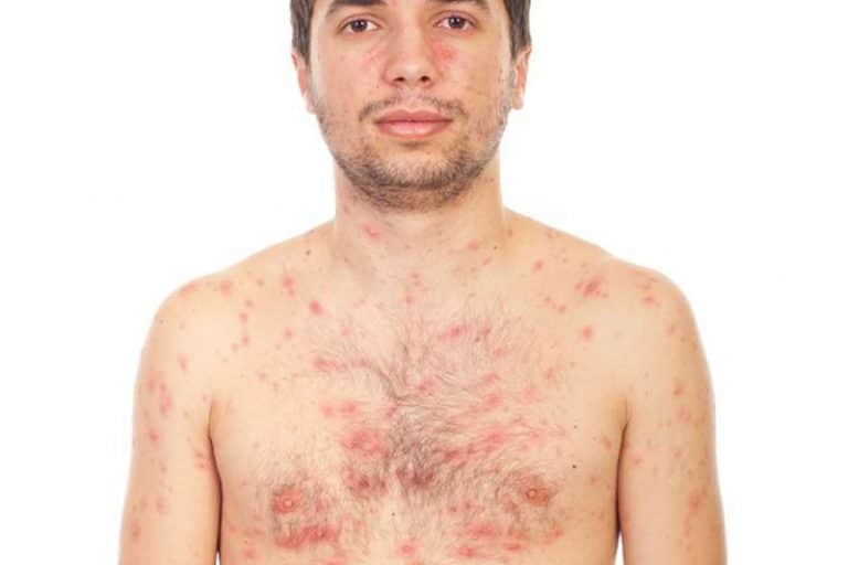 Quels sont les symptômes de la varicelle chez l